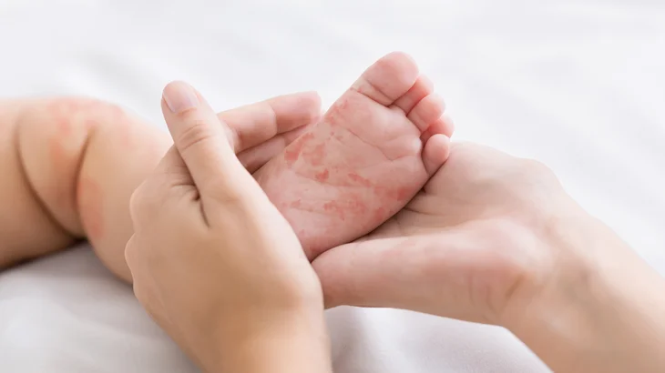 pé do bebê com roséola 