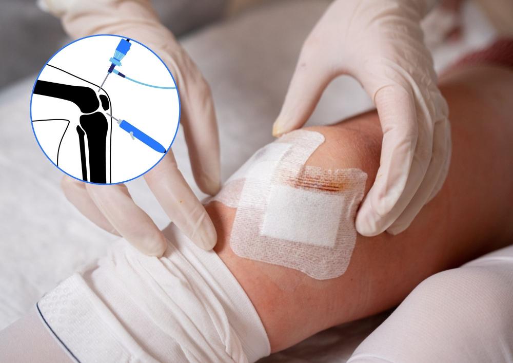 Mãos de profissional de saúde fazendo curativo no joelho de paciente após procedimento de artroscopia de joelho, com curativo e ilustração explicativa de como é feita a cirurgia.